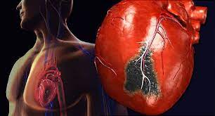 Heart Attacks on the Rise in India: Lifestyle Factors to Blame