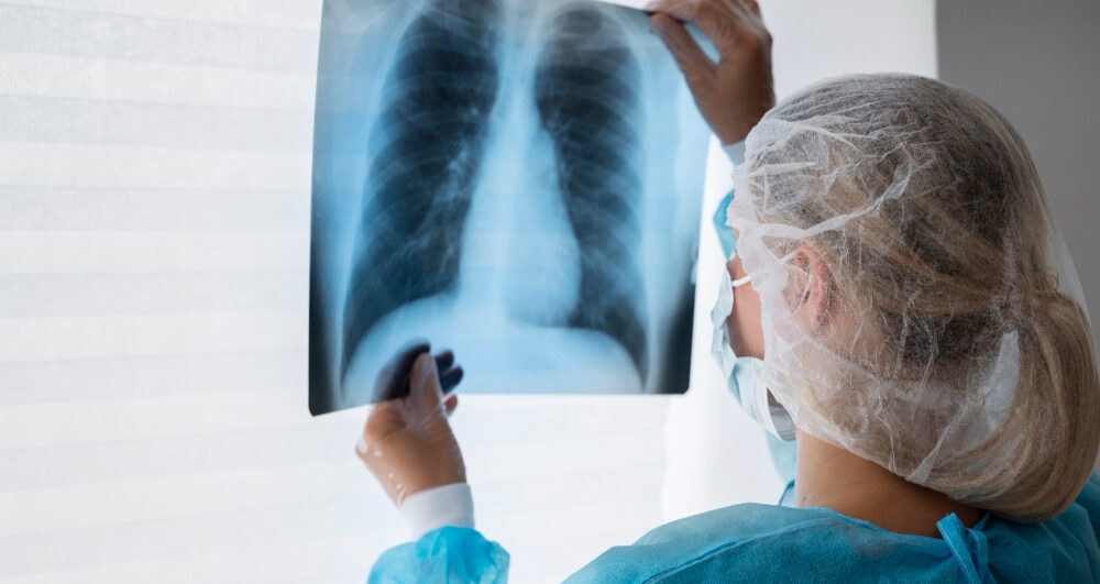Hope in Lung Cancer Fight: Scientists Uncover Key Protein to Halt Spread